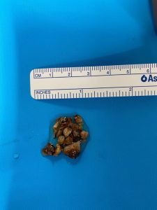 Fragmented kidney stone removed from the patient