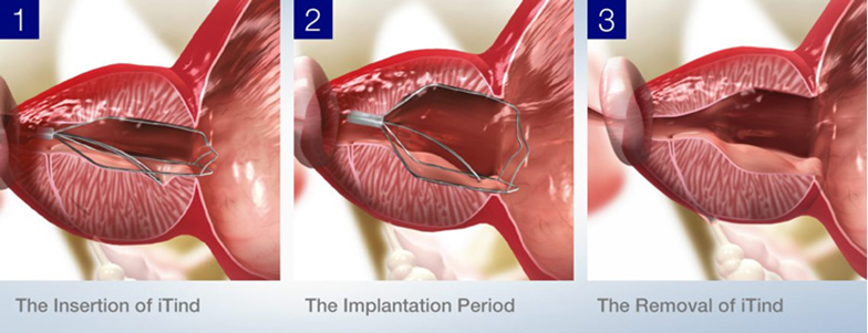 The Insertion of iTind