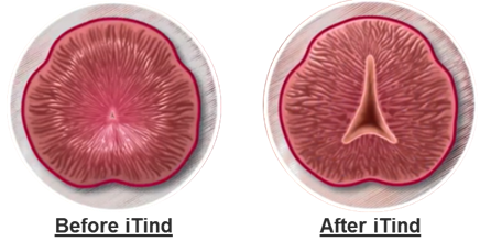 Before and after iTind